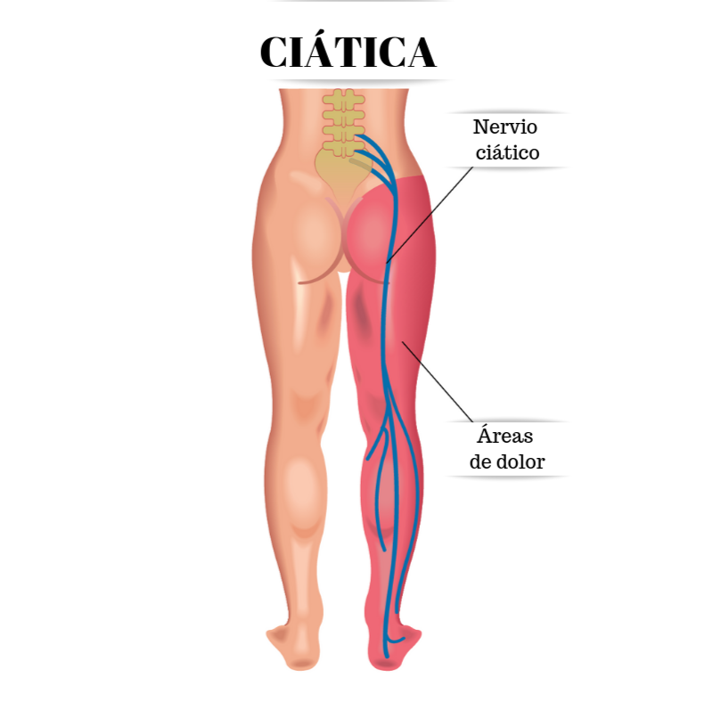 Clínica: ¿Qué es la ciática?